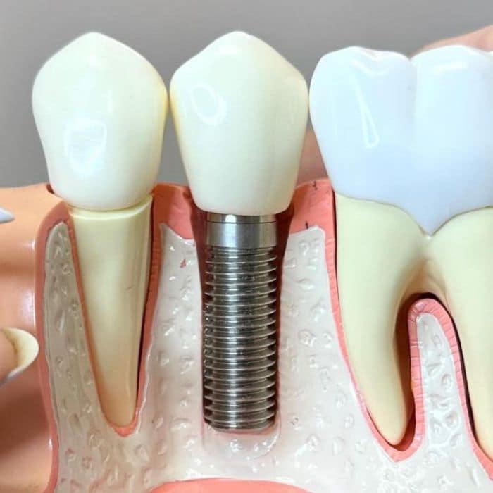 Tooth implant diagram
