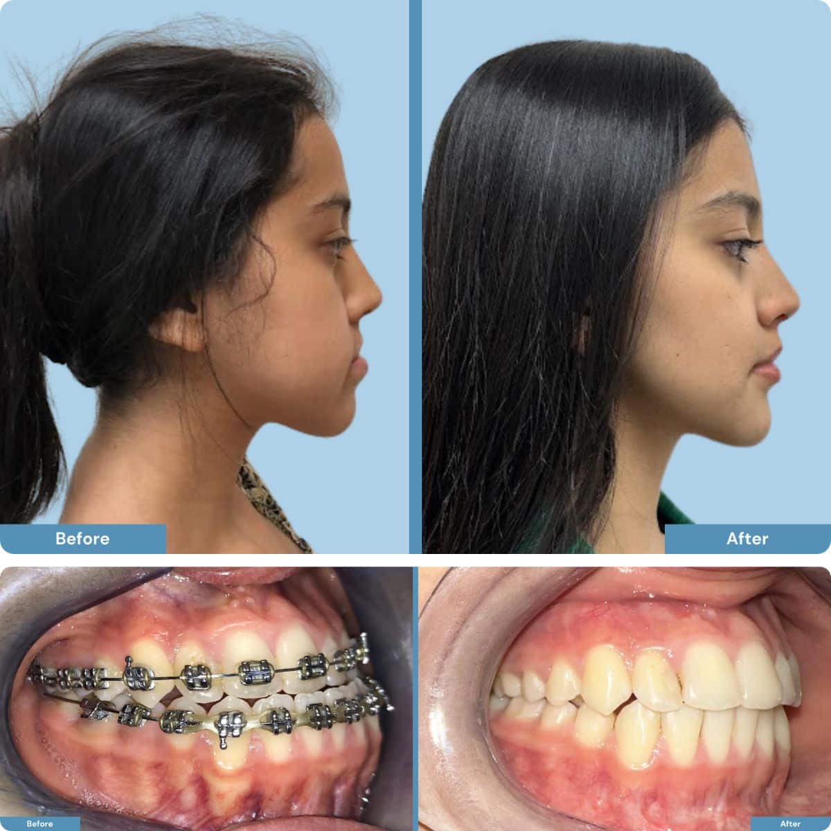 Before and after orthognathic jaw surgery with braces