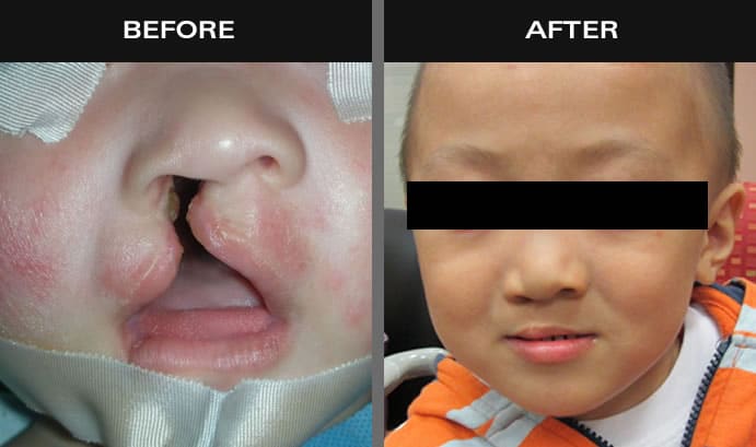 Before and after images of baby with cleft palate in Staten Island