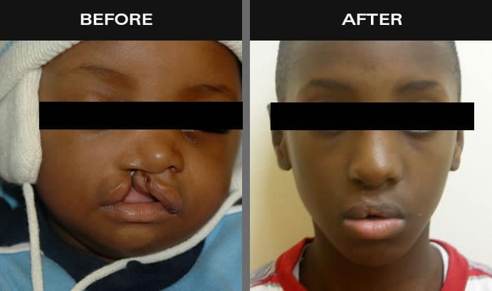 Before and after images of baby with cleft palate in Staten Island, NY