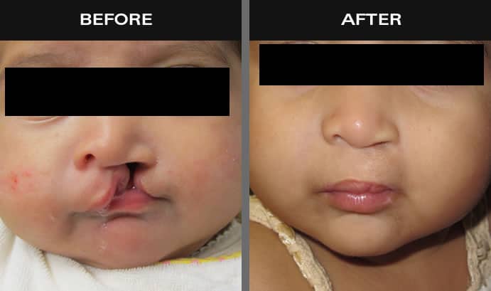 Before and after images of baby with cleft palate in Staten Island, New York