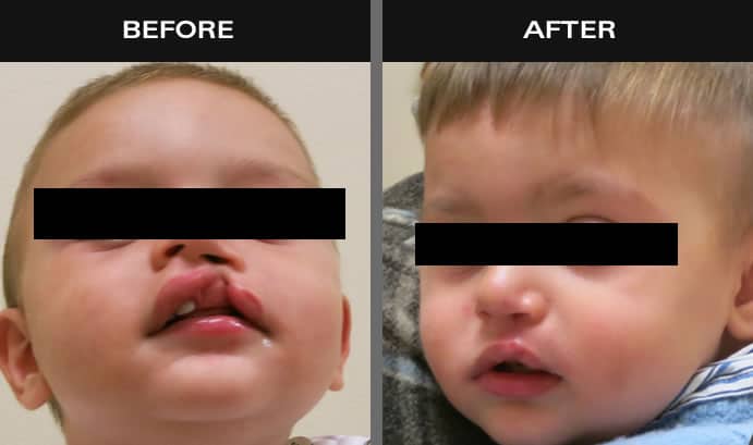 Before and after images of baby with cleft lip