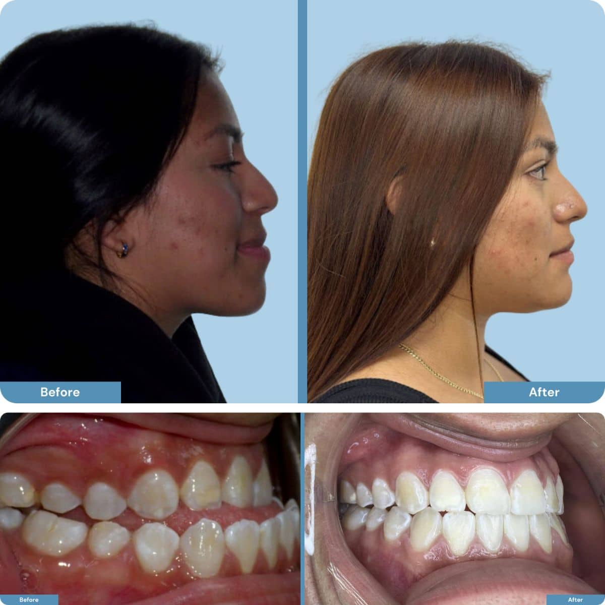 Before and after orthognathic jaw surgery