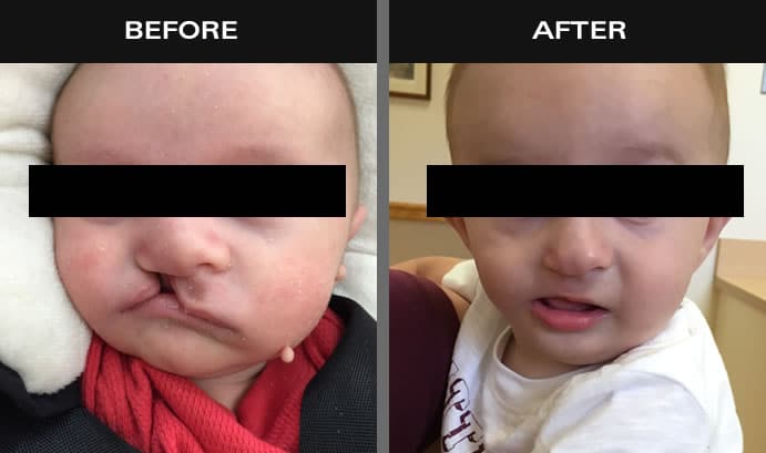 Before and after images of baby with cleft palate