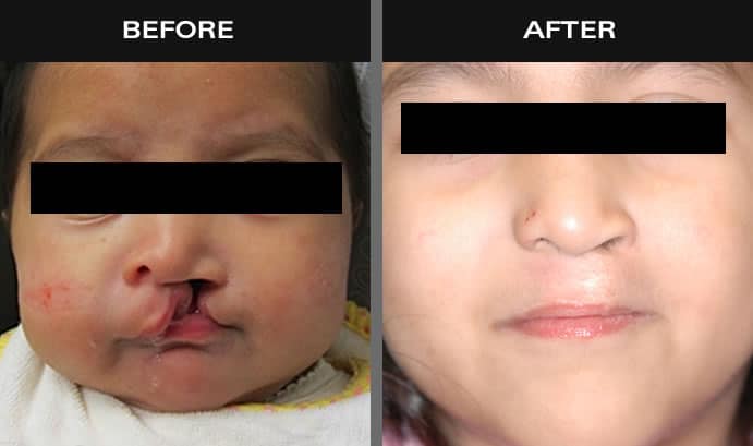 Before and after images of baby with cleft lip and palate in New York