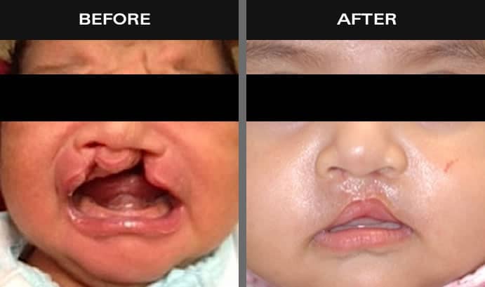 Before and after images of baby with cleft lip in Staten Island