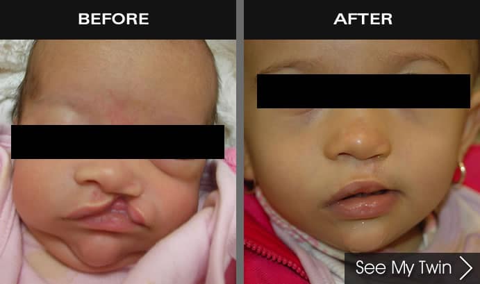 Before and after images of baby with cleft lip and palate