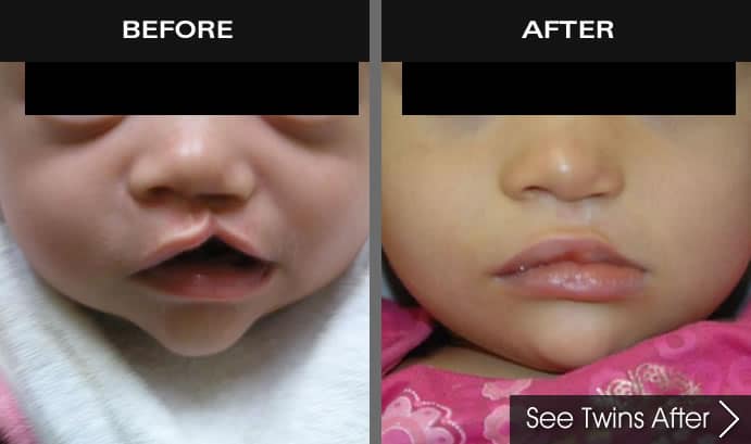 Before and after images of baby with cleft palate in New York
