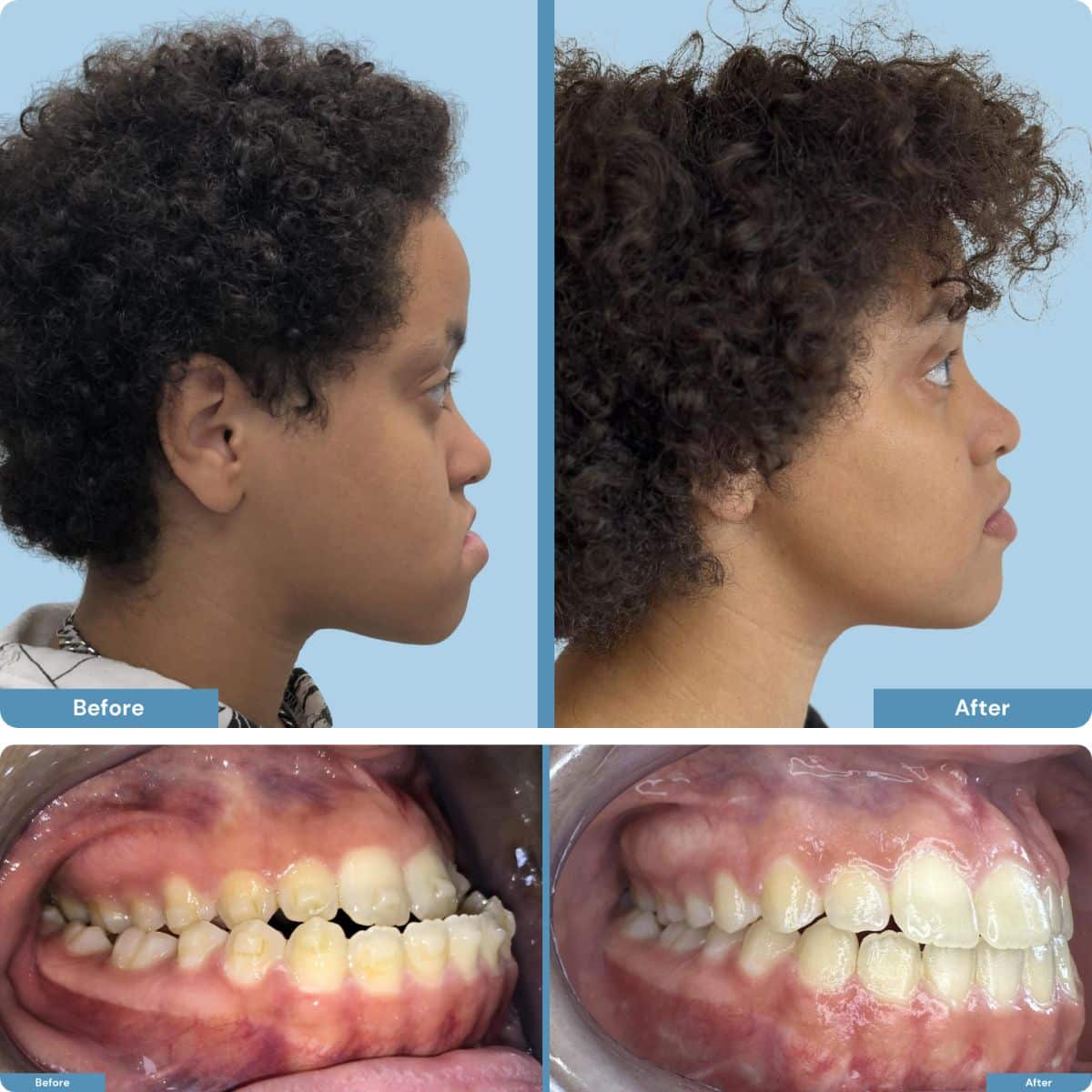 Before and after orthognathic jaw surgery on young person