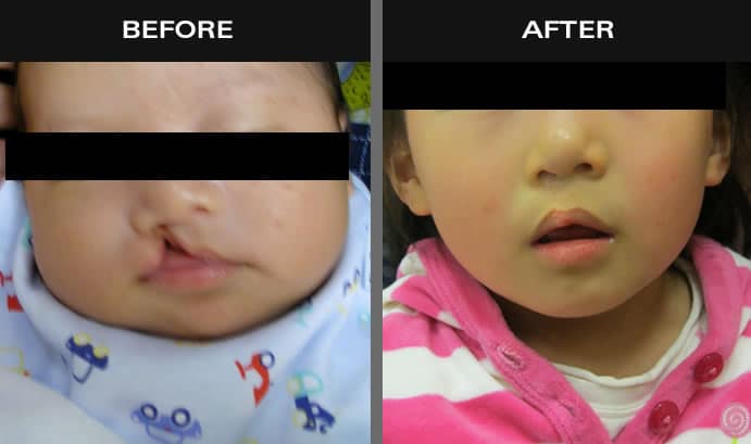 Before and after images of baby with cleft palate