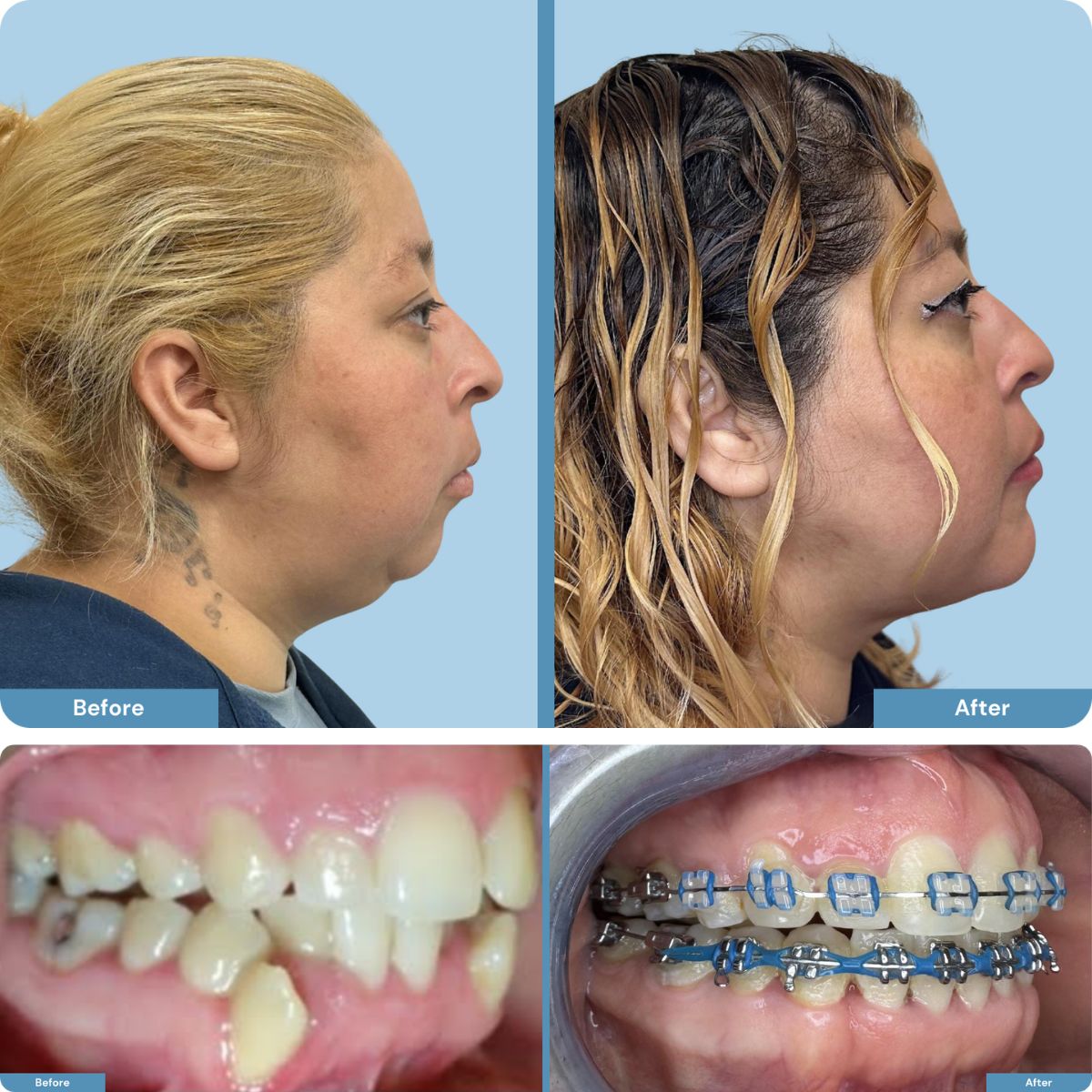 Before and after orthognathic jaw surgery on person