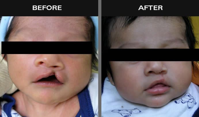 Before and after images of baby with cleft palate in NY
