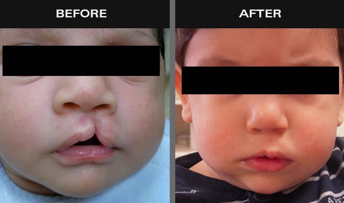 Before and after images of baby with cleft palate in New York