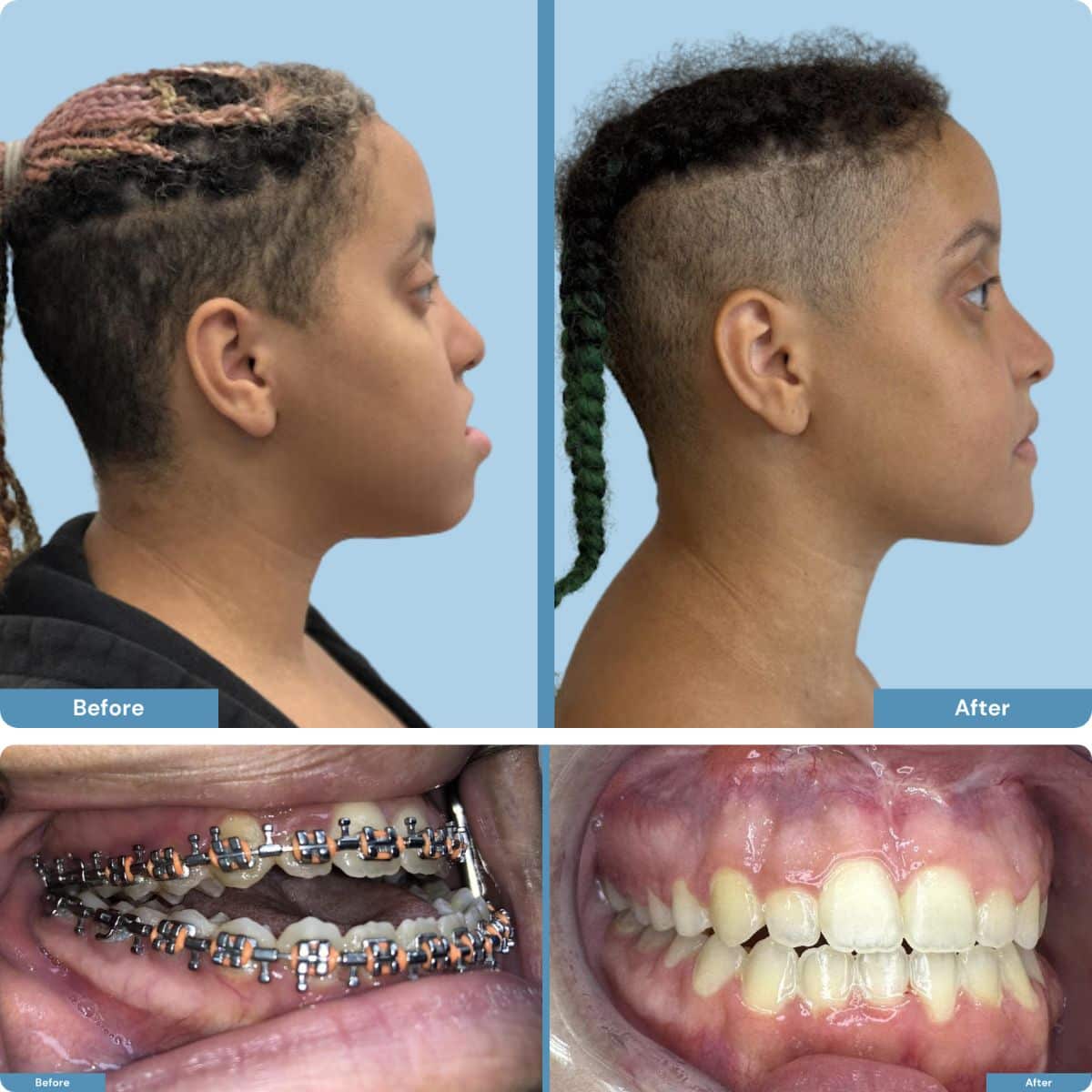 Before and after orthognathic jaw surgery on young person