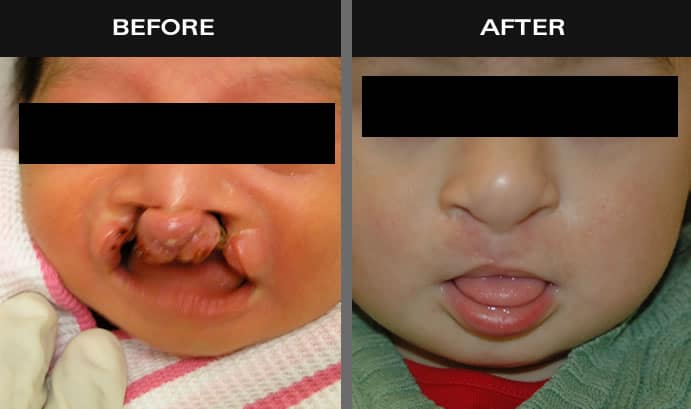 Before and after images of baby with cleft lip in New York