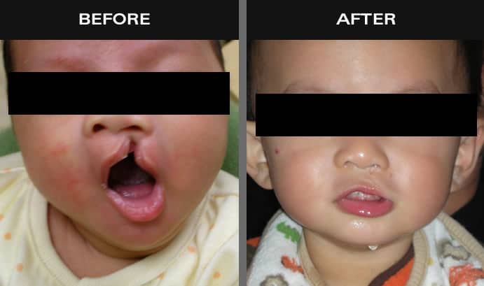 Before and after images of baby with cleft lip and palate in New York
