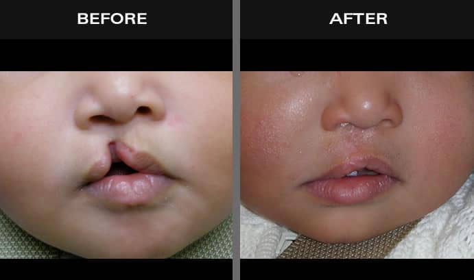 Before and after images of baby with cleft lip and palate in Staten Island
