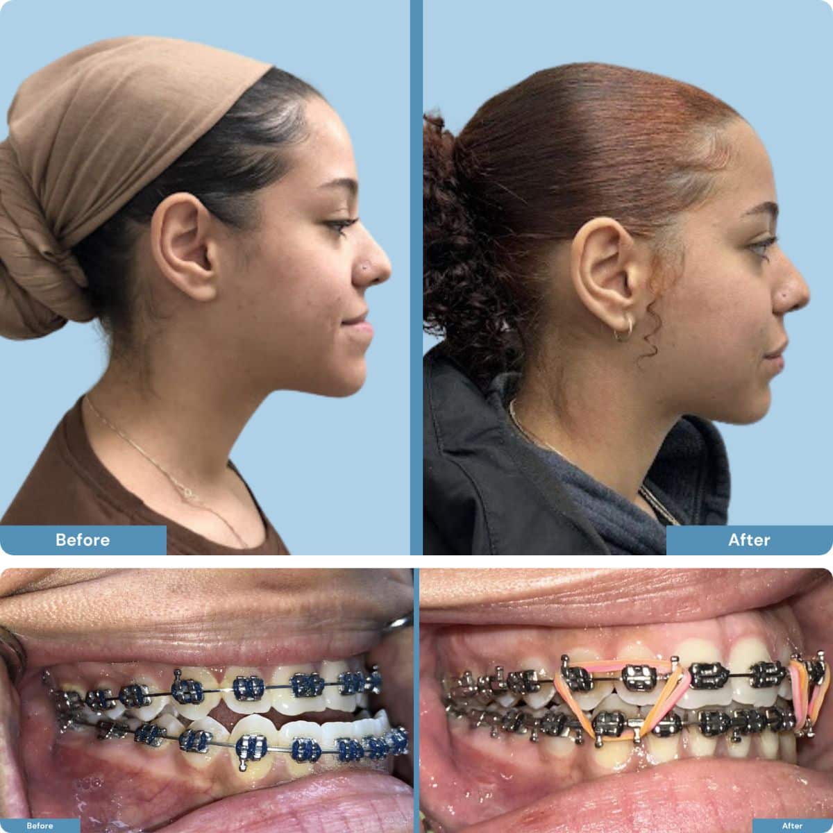 Before and after orthognathic jaw surgery on young girl
