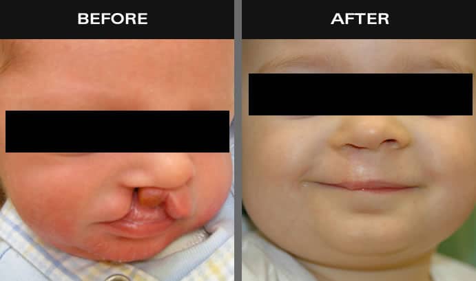Before and after images of baby with cleft lip in Staten Island