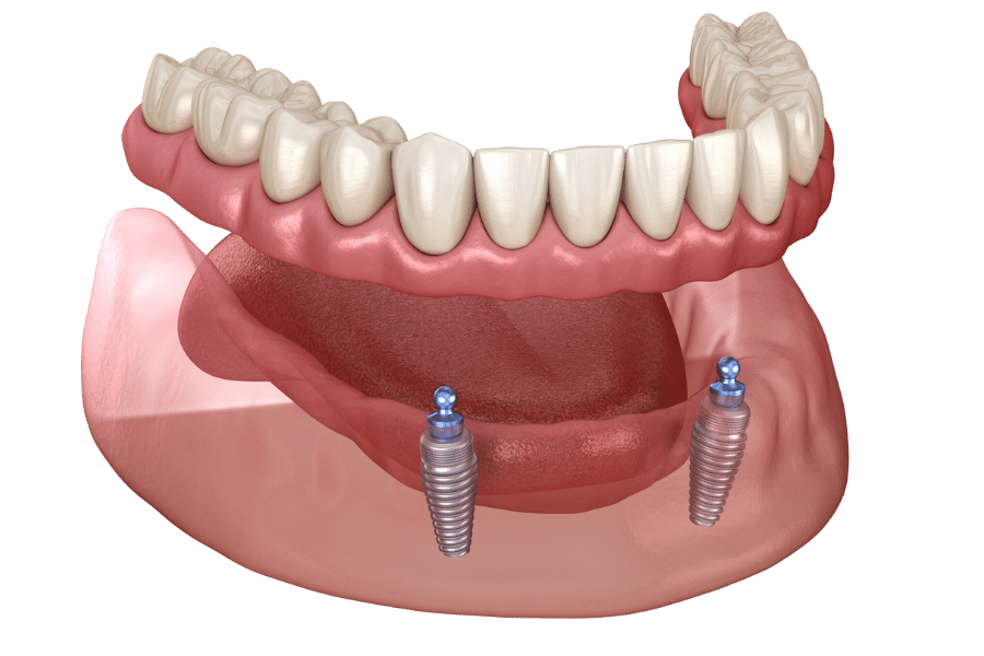 Illustration of two bottom dental implants