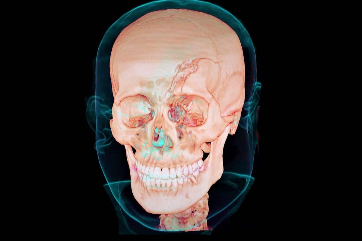 Skull smiling displaying facial trauma