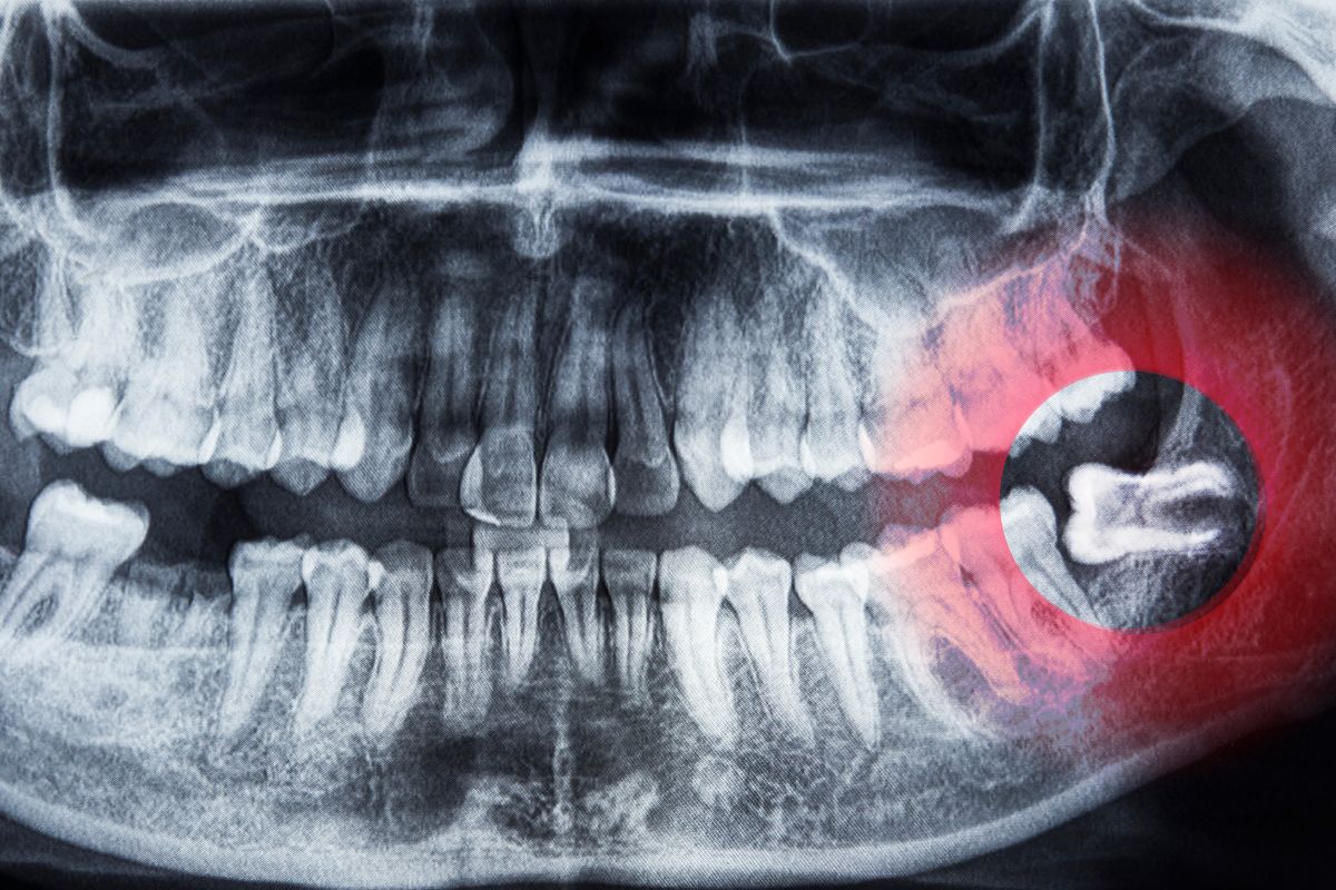 Xray showing impacted wisdom tooth in staten island