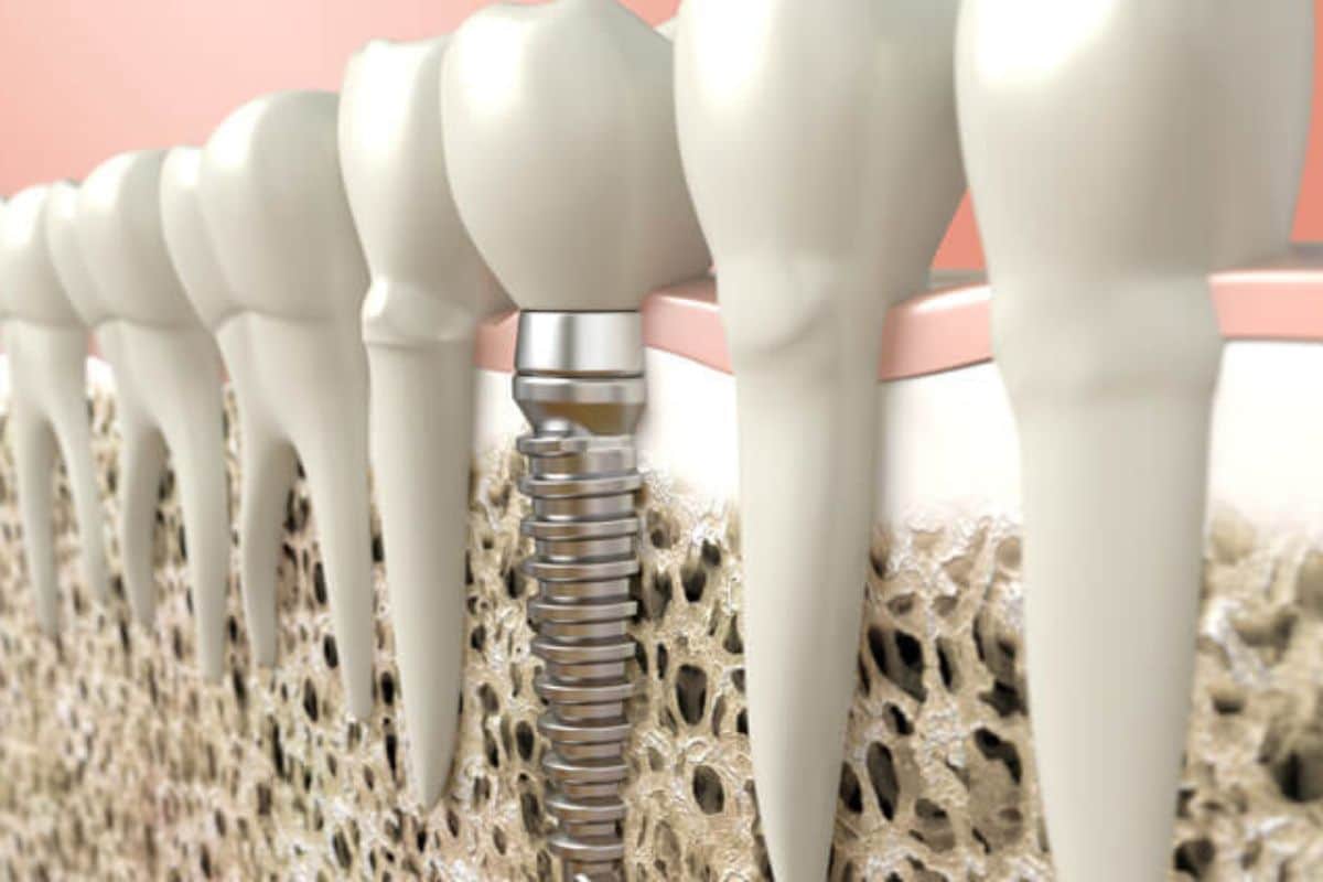 Illustration of tooth bone graft