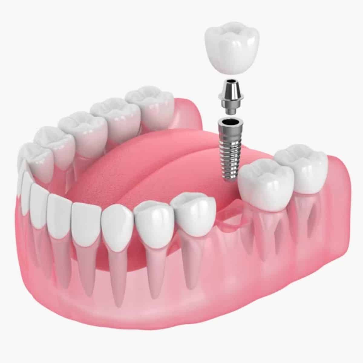 Illustration of dental implant with screw going into mouth
