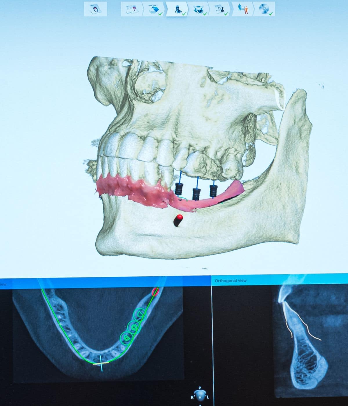 Virtual Oral Surgery Planning xray